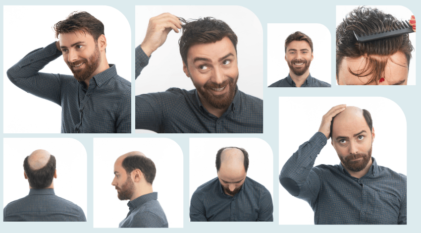 بهترین روش پرپشت کردن موی سر