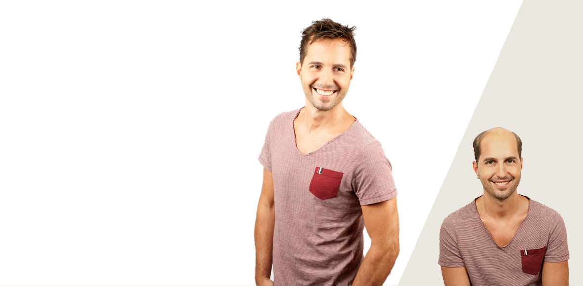 پروتز مو بهتر است یا کاشت مو