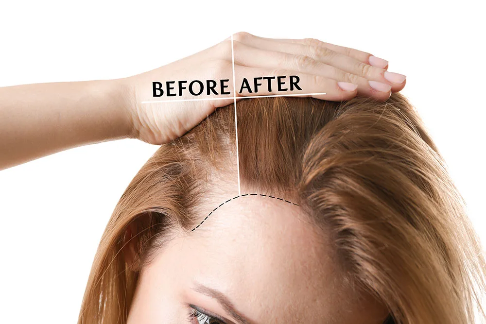 img Hair Transplant For Women How Does It Work